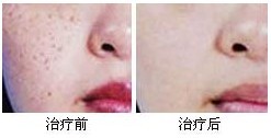 雀斑