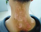 治疗牛皮癣的相关因素
