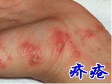 疥疮结节要怎么治疗