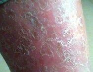 深圳牛皮癣治疗中心哪家医院好