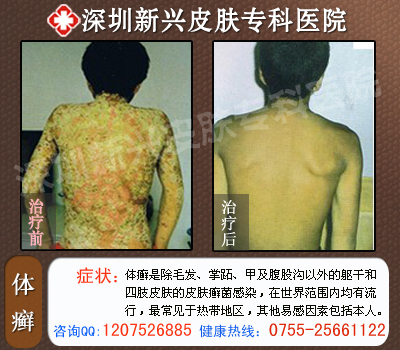 深圳新兴医院患者康复前后对比